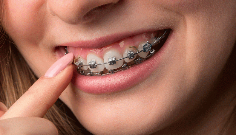 ORTHOSPE 790x453 1 ORTHODONTIE