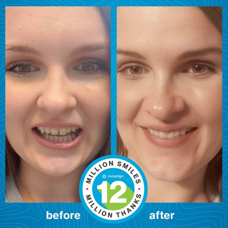 Radiance Dental Center invisalign tanger 3