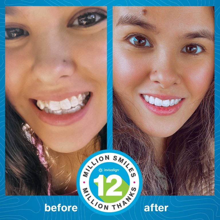 Radiance Dental Center invisalign tanger 4