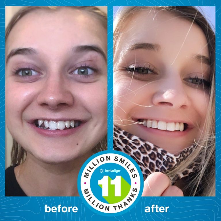 Radiance Dental Center invisalign tanger 6
